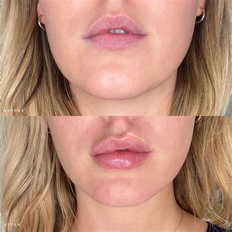 lip flip nyc|Lip Fillers NYC 